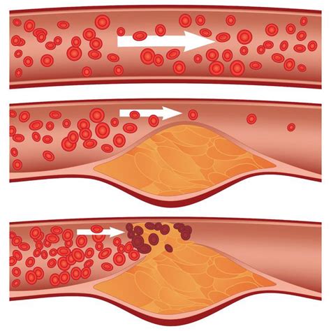 Coronary Artery Disease Atherosclerosis - Cardiology - Highland Hospital - University of ...