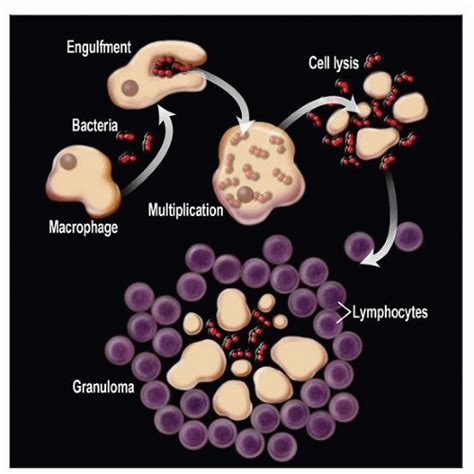 Chronic Granulomatous Lymphadenitis | Basicmedical Key