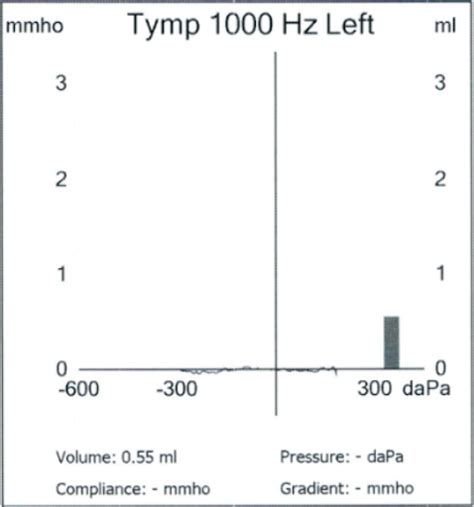 Tympanometry: What It Is and Types of Tympanogram Readings