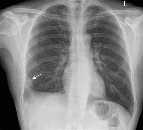 Pulmonary Embolus