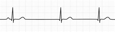 Junctional Escape Rhythm | Bradyarrhythmias - MedSchool