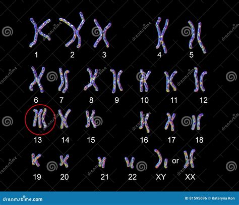 Patau Syndrome Karyotype Royalty-Free Stock Photography | CartoonDealer ...