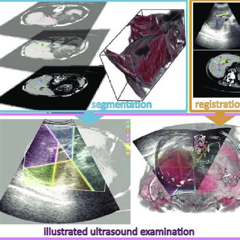 Interactive illustrated ultrasound showing a Couinaud segmentation on ...