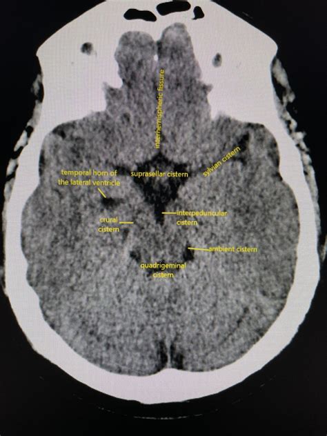 Basal Cisterns Anatomy