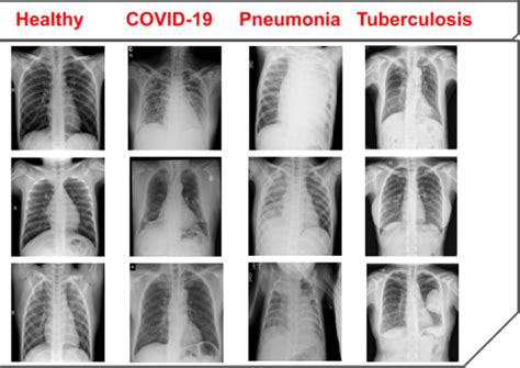 A sample of healthy, COVID-19, pneumonia, and tuberculosis cases from... | Download Scientific ...