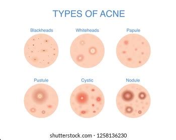 Skin Nodule Royalty-Free Images, Stock Photos & Pictures | Shutterstock