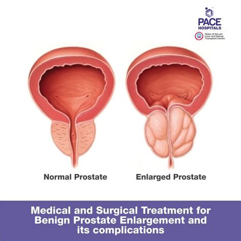 Enlarged Prostate Treatment