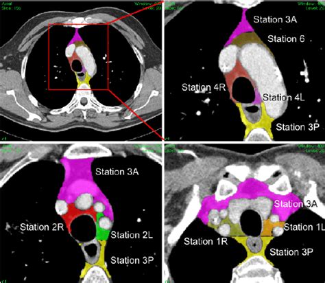 Mediastinal Lymph Nodes Ct Scan