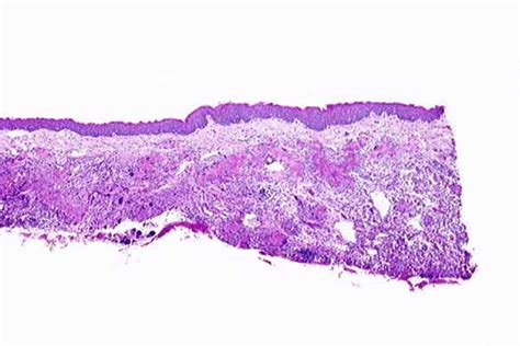 Eosinophilic Granuloma Histology