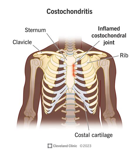 Costochondritis: What It Is, Causes, FAQs & Treatment