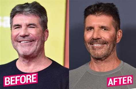 Simon Cowell Plastic Surgery Makeover Exposed By Top Docs