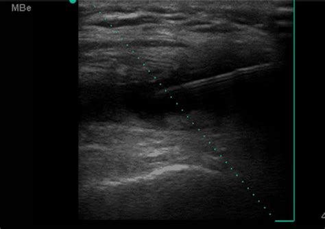 Superolateral recess – aspiration and injection approach