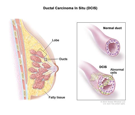 Ductal carcinoma in situ (DCIS) Management and Diagnosis