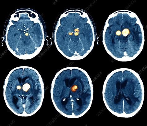 Brain Cancer Ct Scan