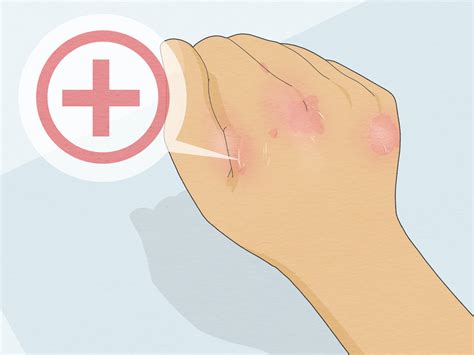 How to Heal Cracked Skin (with Pictures) - wikiHow