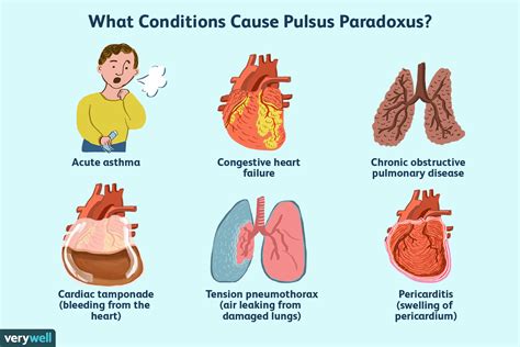 Wat is Pulsusparadoxus? - Med NL