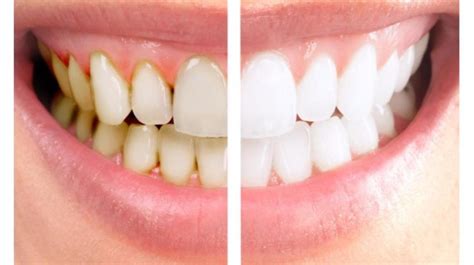 Teeth Scaling Procedure | News | Dentagama