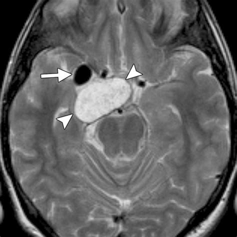 Cerebral Aneurysm Mri