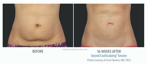 CoolSculpting before and after | Real Patient Photos - Vein & Laser Institute