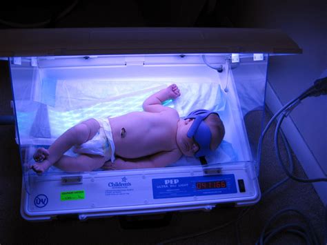 Baked Bean | Baby Victor Santino Phototherapy Infants with n… | Flickr