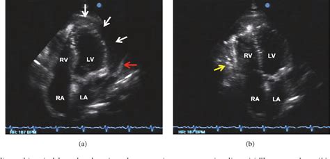 [PDF] A Rare Case of Pneumopericardium in the Setting of Tuberculous Constrictive Pericarditis ...