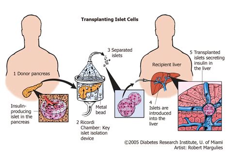 Pancreatic transplantation: Brief review of the current evidence