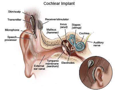 Cochlear Implants: What to Expect During Surgery