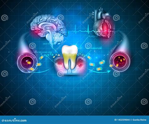 Inflamed gums stock vector. Illustration of healthy - 143259844