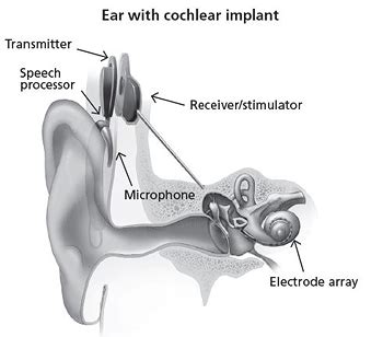 What Are Cochlear Implants for Hearing? | NIDCD