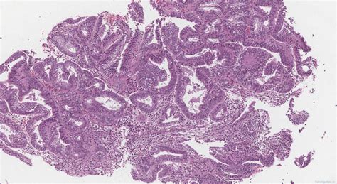 Endometrial Hyperplasia