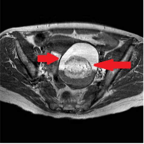 Ovarian mature cystic teratoma: MR imaging findings | Eurorad