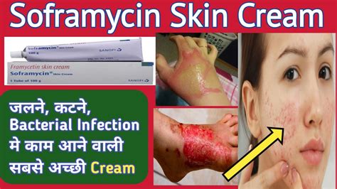 Soframycin Cream Uses | Framycetin Lotion | Best lotion for Infected Wounds and Burn #cream_for ...