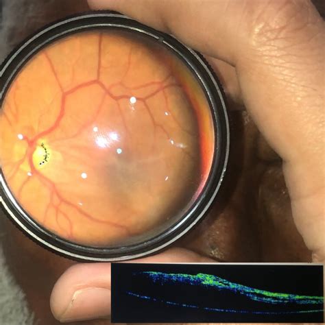 Macular puckering - American Academy of Ophthalmology