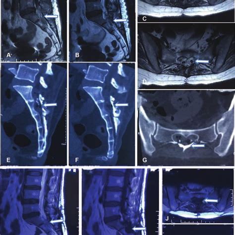 A, Sagittal MRI T2-weighted image showing multiple sacral canal cysts... | Download Scientific ...