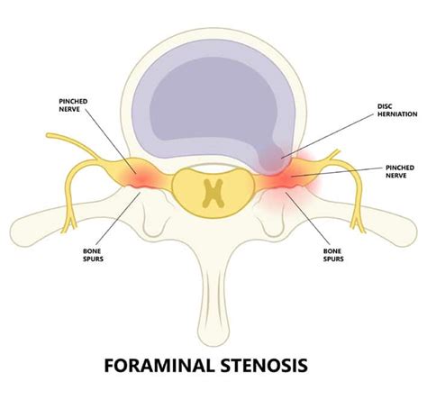 Foraminal Stenosis: What It Is and What Are the Symptoms?