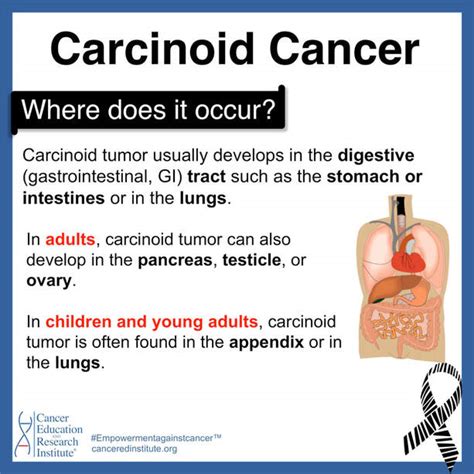 Carcinoid Cancer - Cancer Education and Research Institute