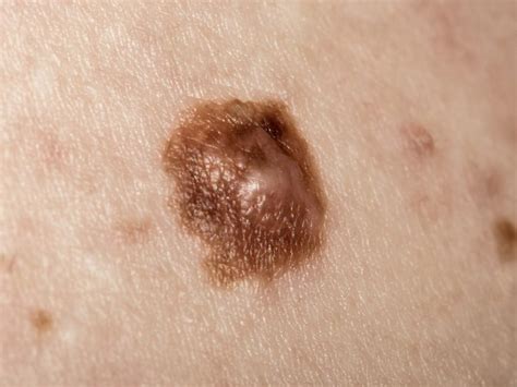 Melanoma: Stages, types, causes, and pictures