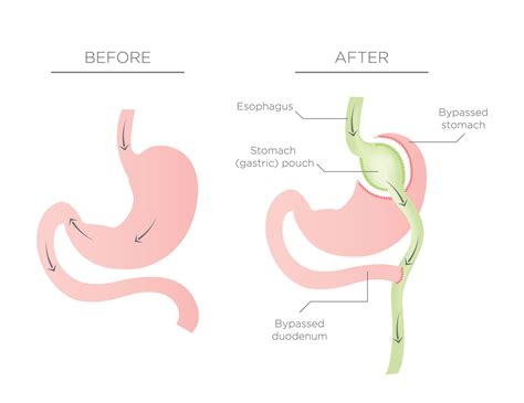 Gastric Bypass Recovery - Puerto Vallarta, JAL Post-Bariatric Patient ...