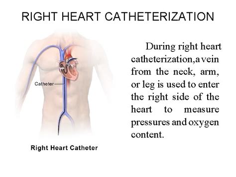 Cardiac Catheterization