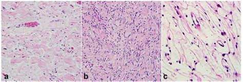 Benign nerve sheath tumor in NF1 Some benign nerve sheath tumors may be... | Download Scientific ...