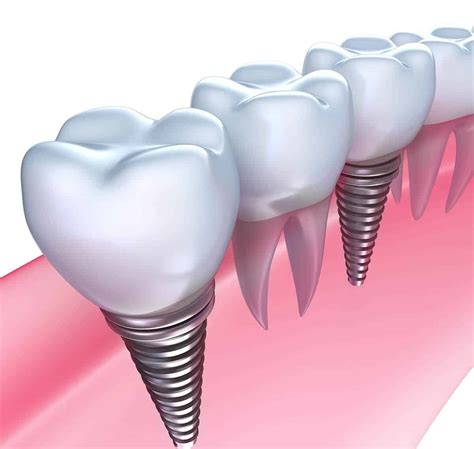 Are Dental Implants Safe? - Risks and Problems Involved - Advanced ...