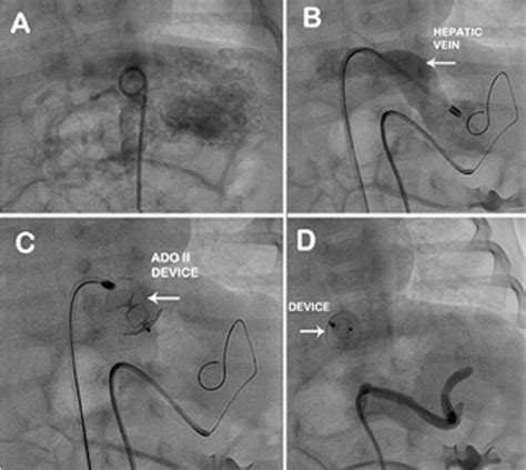 A. Abdominal aortogram with pig tail catheter shows IHH.B: 4 F Terumo... | Download Scientific ...