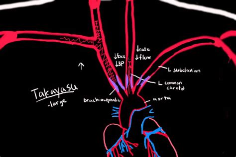 Takayasu Arteritis - YouTube