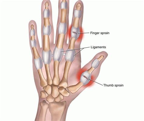 Thumb Sprain: Symptoms & Treatment