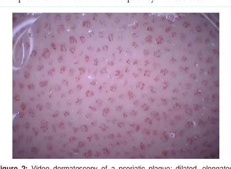 Figure 2 from Dermatoscopy and Video Dermatoscopy in the Diagnosis and Therapeutic Monitoring of ...