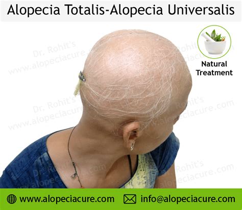 Alopecia Universalis