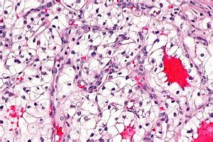 Clear cell renal cell carcinoma - Libre Pathology