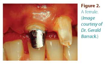 Benefit of Ferrule or Post in Endodontically Treated Teeth - BC Endo