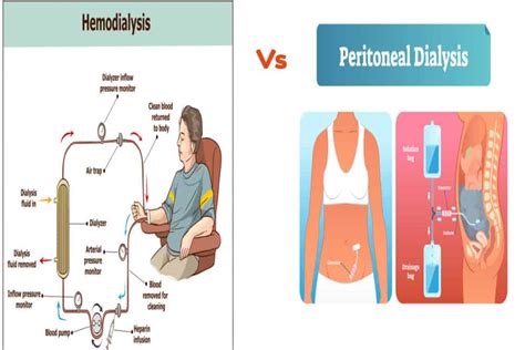 Peritoneal Dialysis Vs Hemodialysis: EASY To Understand Article