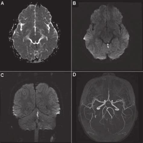 MRI of cerebellar stroke in a child one day after seasonal trivalent... | Download Scientific ...